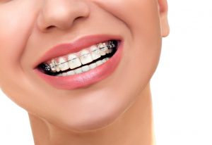 Read more about the article Mituri despre aparatul dentar